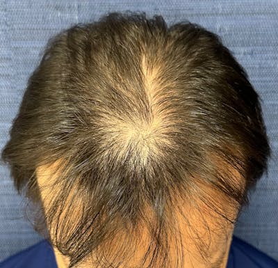 Non-Surgical Gallery Before & After Gallery - Patient 160987 - Image 2