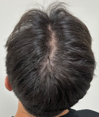 Non-Surgical Gallery Before & After Gallery - Patient 160987 - Image 4