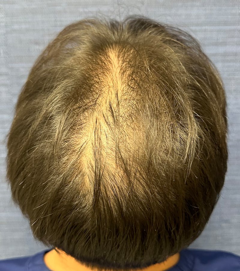 Non-Surgical Gallery Before & After Gallery - Patient 160987 - Image 3