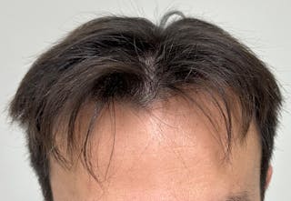 Non-Surgical Gallery Before & After Gallery - Patient 160987 - Image 6