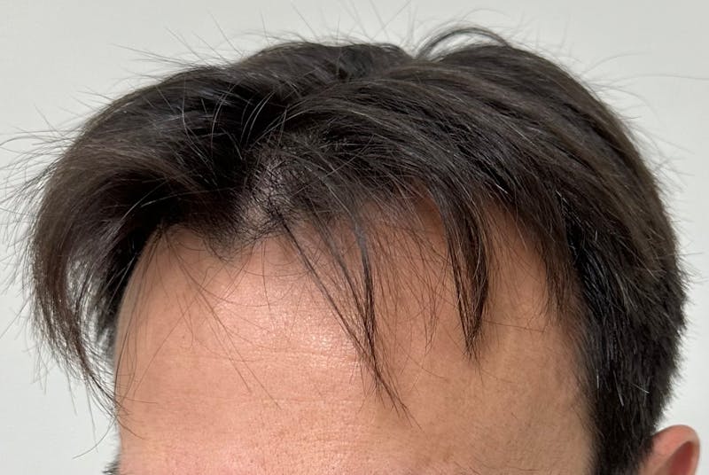 Non-Surgical Gallery Before & After Gallery - Patient 160987 - Image 10