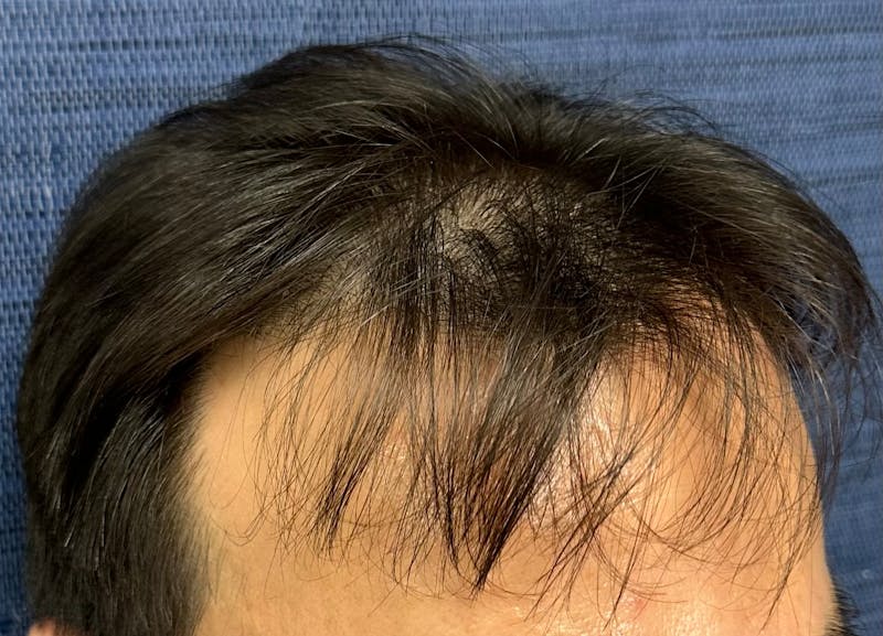 Non-Surgical Gallery Before & After Gallery - Patient 160987 - Image 7