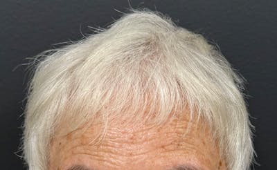 Non-Surgical Gallery Before & After Gallery - Patient 302787 - Image 2