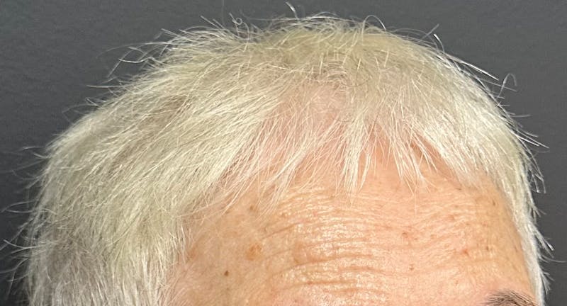 Non-Surgical Gallery Before & After Gallery - Patient 302787 - Image 3