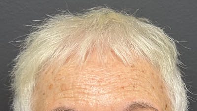 Non-Surgical Gallery Before & After Gallery - Patient 302787 - Image 1