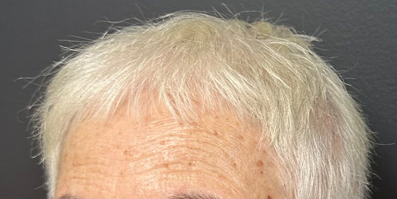 Non-Surgical Gallery Before & After Gallery - Patient 302787 - Image 5