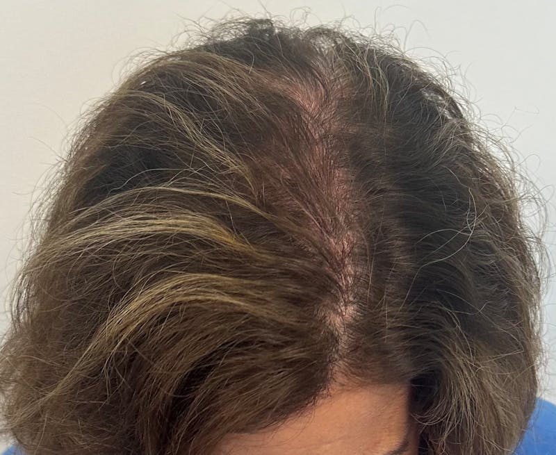 Non-Surgical Gallery Before & After Gallery - Patient 410195 - Image 4