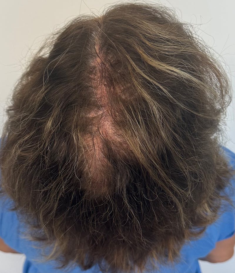 Non-Surgical Gallery Before & After Gallery - Patient 410195 - Image 2