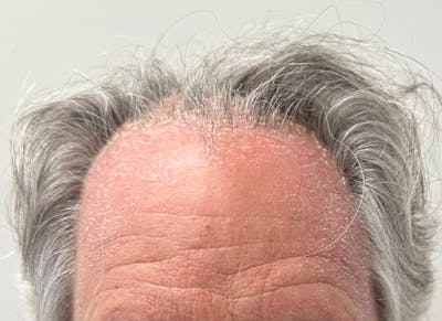 Non-Surgical Gallery Before & After Gallery - Patient 148056 - Image 1