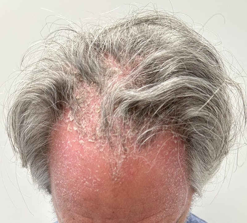 Non-Surgical Gallery Before & After Gallery - Patient 148056 - Image 3