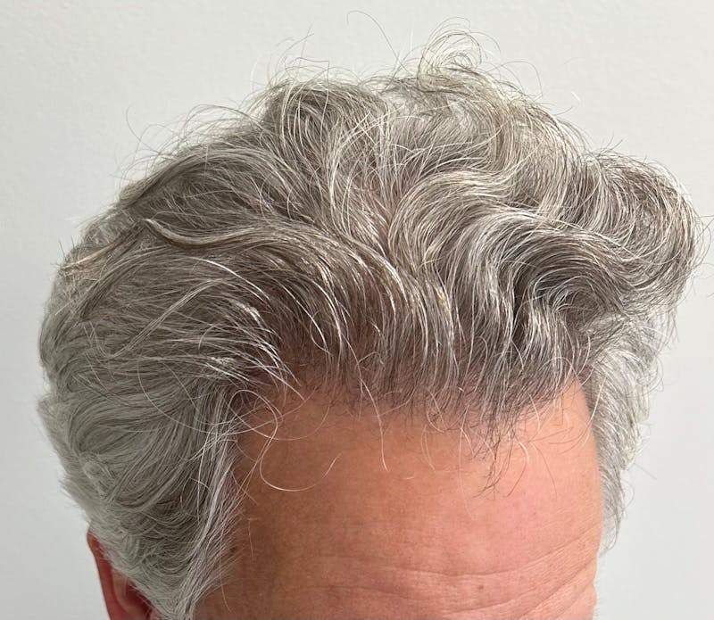 Non-Surgical Gallery Before & After Gallery - Patient 148056 - Image 6