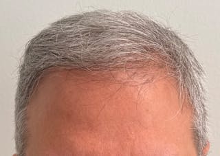 Non-Surgical Gallery Before & After Gallery - Patient 224533 - Image 2