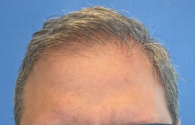 Non-Surgical Gallery Before & After Gallery - Patient 224533 - Image 1