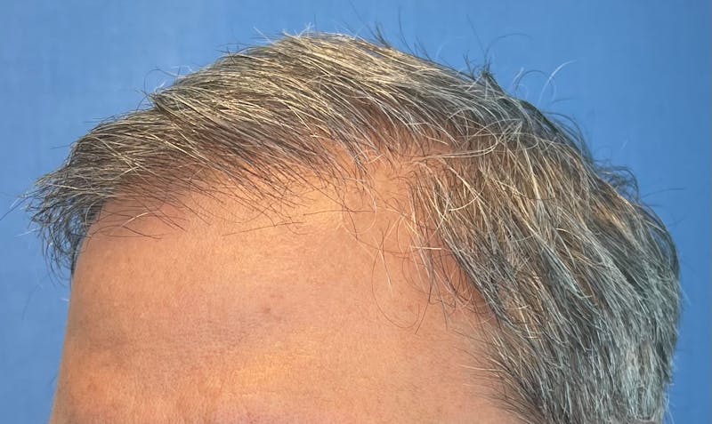 Non-Surgical Gallery Before & After Gallery - Patient 224533 - Image 5