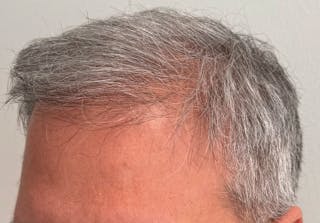 Non-Surgical Gallery Before & After Gallery - Patient 224533 - Image 6