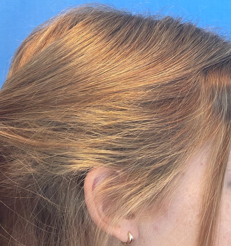 Non-Surgical Gallery Before & After Gallery - Patient 106968 - Image 4