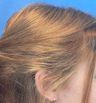 Non-Surgical Gallery Before & After Gallery - Patient 106968 - Image 4