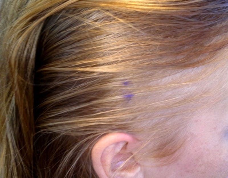 Non-Surgical Gallery Before & After Gallery - Patient 106968 - Image 3