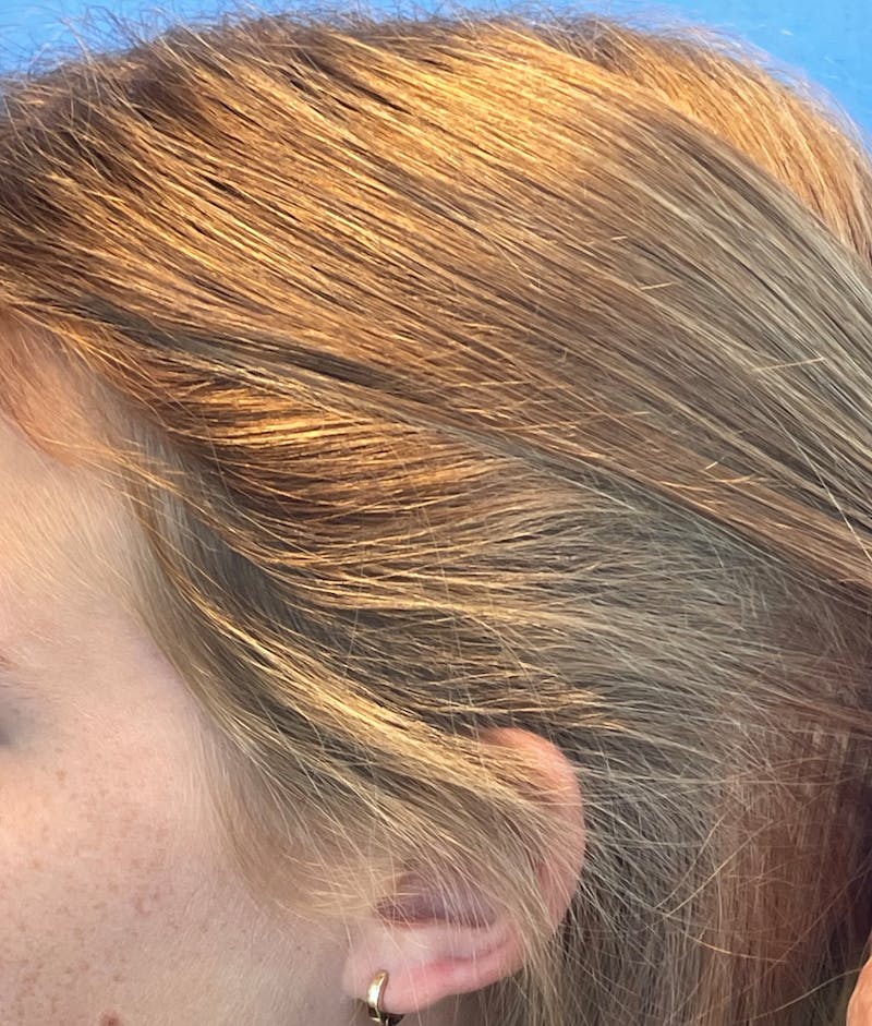 Non-Surgical Gallery Before & After Gallery - Patient 106968 - Image 6