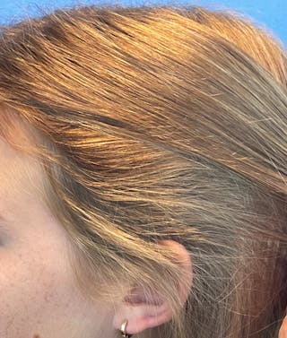 Non-Surgical Gallery Before & After Gallery - Patient 106968 - Image 6