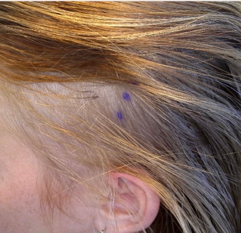 Non-Surgical Gallery Before & After Gallery - Patient 106968 - Image 5