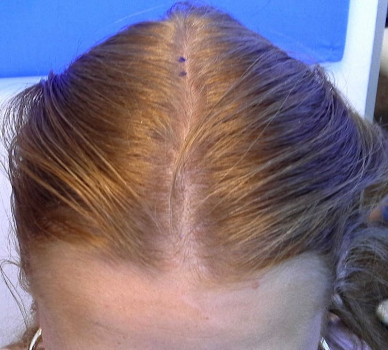 Non-Surgical Gallery Before & After Gallery - Patient 106968 - Image 1