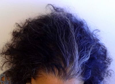 Non-Surgical Gallery Before & After Gallery - Patient 417318 - Image 2