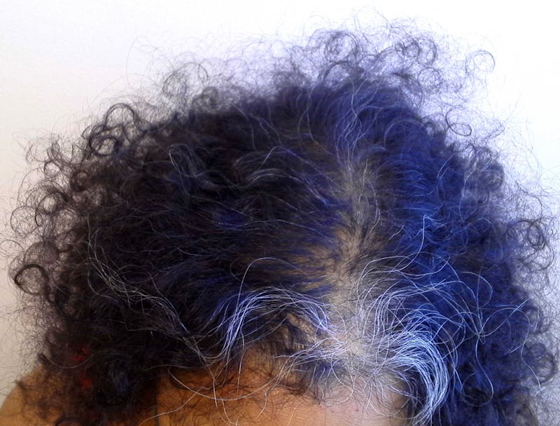 Non-Surgical Gallery Before & After Gallery - Patient 417318 - Image 1
