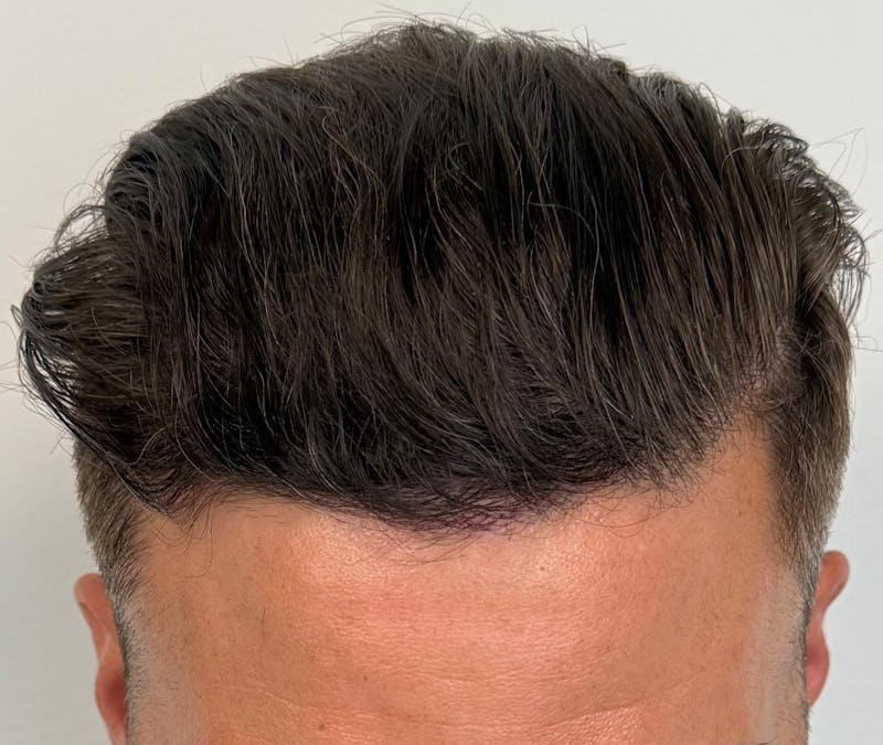 Male Surgical Gallery Before & After Gallery - Patient 317606 - Image 2