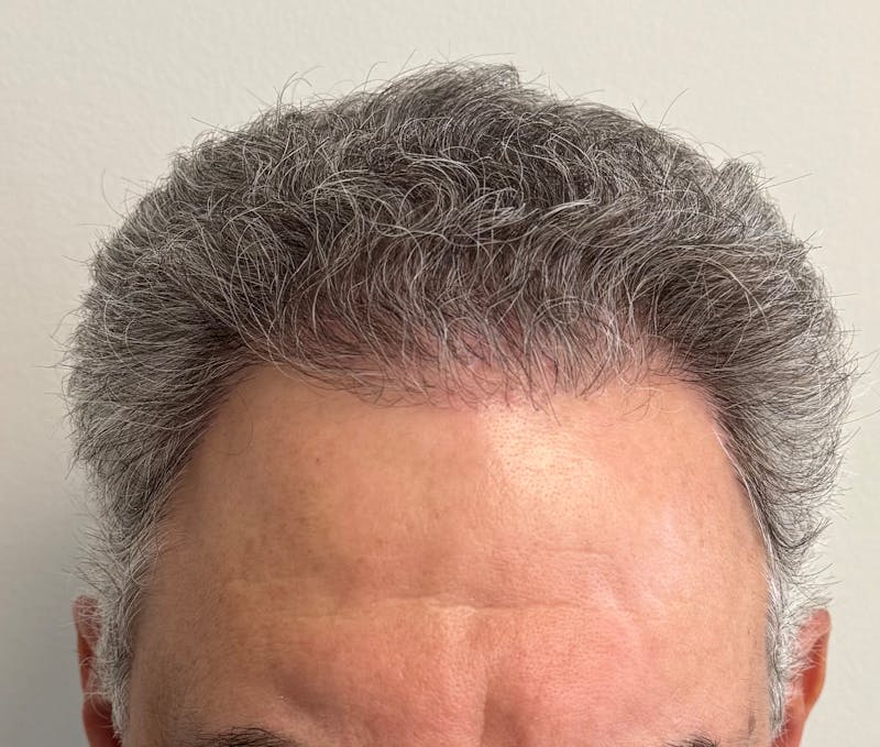 Male Surgical Gallery Before & After Gallery - Patient 142512 - Image 2