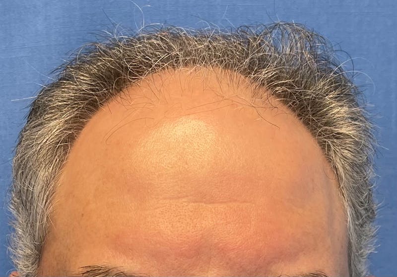 Male Surgical Gallery Before & After Gallery - Patient 142512 - Image 1