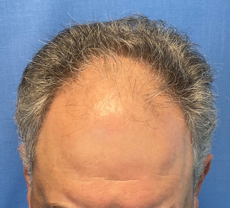 Male Surgical Gallery Before & After Gallery - Patient 142512 - Image 3