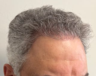 Male Surgical Gallery Before & After Gallery - Patient 142512 - Image 6