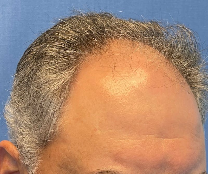 Male Surgical Gallery Before & After Gallery - Patient 142512 - Image 5