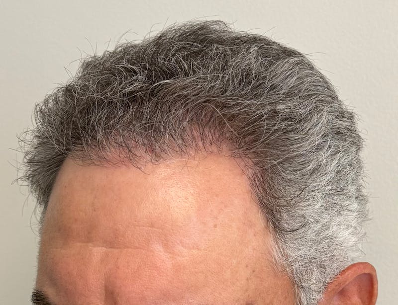 Male Surgical Gallery Before & After Gallery - Patient 142512 - Image 8