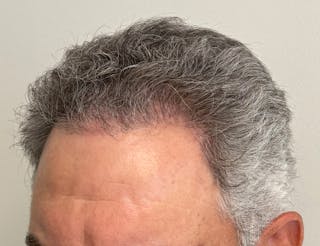 Male Surgical Gallery Before & After Gallery - Patient 142512 - Image 8