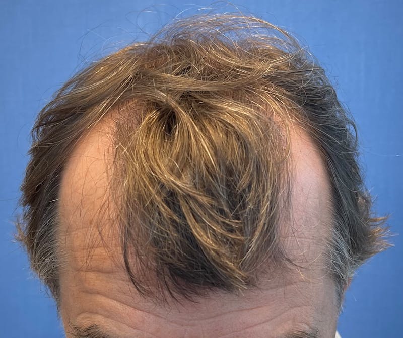 Male Surgical Gallery Before & After Gallery - Patient 319833 - Image 1