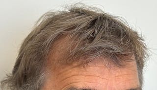 Male Surgical Gallery Before & After Gallery - Patient 319833 - Image 6