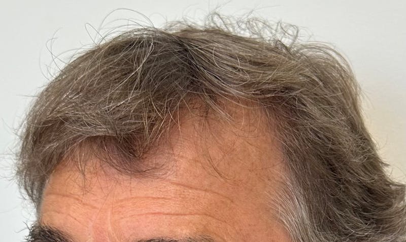 Male Surgical Gallery Before & After Gallery - Patient 319833 - Image 8