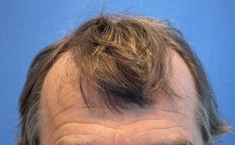 Male Surgical Gallery Before & After Gallery - Patient 319833 - Image 3