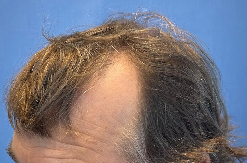 Male Surgical Gallery Before & After Gallery - Patient 319833 - Image 7