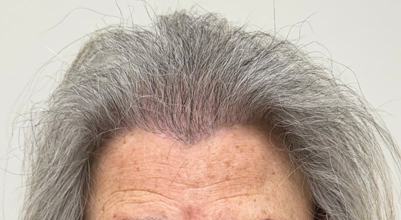 Female Surgical Gallery Before & After Gallery - Patient 191596 - Image 4