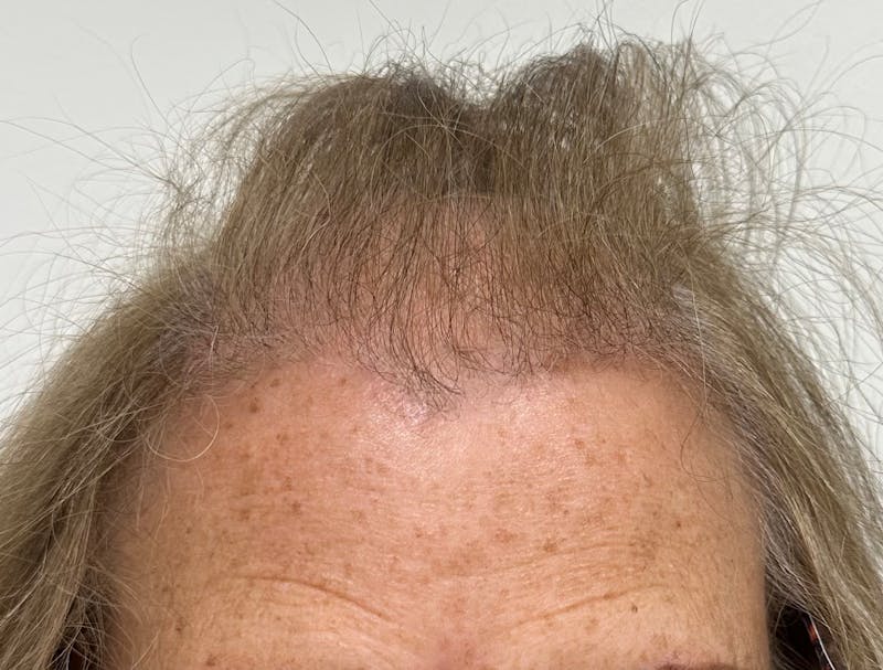 Female Surgical Gallery Before & After Gallery - Patient 191596 - Image 3