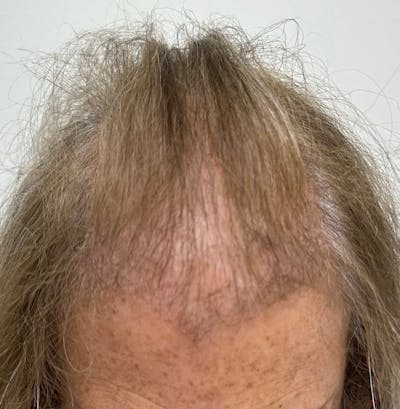 Female Surgical Gallery Before & After Gallery - Patient 191596 - Image 1