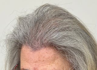 Female Surgical Gallery Before & After Gallery - Patient 191596 - Image 8