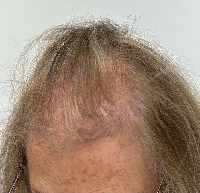 Female Surgical Gallery Before & After Gallery - Patient 191596 - Image 7