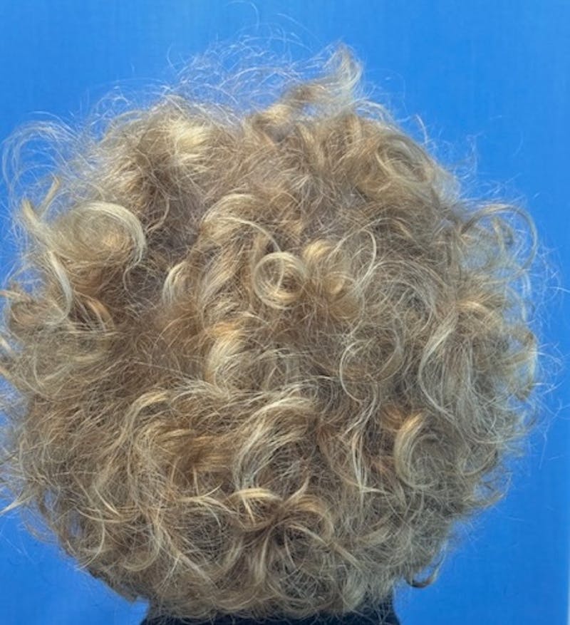 Non-Surgical Gallery Before & After Gallery - Patient 267760 - Image 6