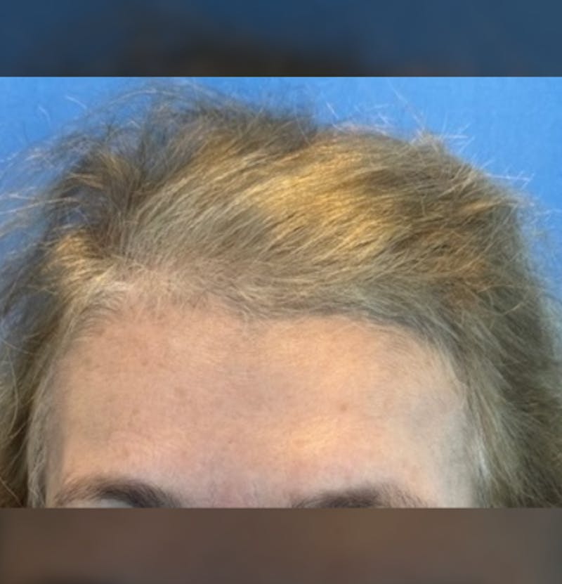 Non-Surgical Gallery Before & After Gallery - Patient 267760 - Image 3