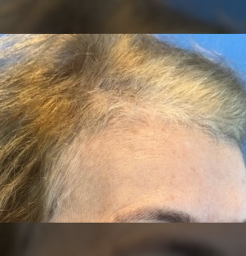 Non-Surgical Gallery Before & After Gallery - Patient 267760 - Image 11