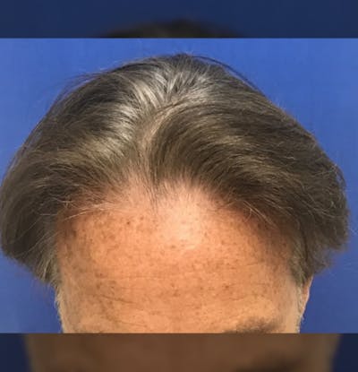 Male Surgical Gallery Before & After Gallery - Patient 279020 - Image 1